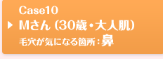 Case10 Mさん（30歳・大人肌）毛穴が気になる箇所：鼻