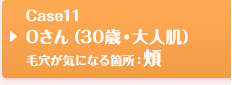 Case11 Oさん（26歳・大人肌）毛穴が気になる箇所：頬