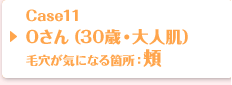 Case11 Oさん（26歳・大人肌）毛穴が気になる箇所：頬