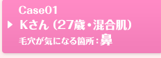 Case01 Kさん（27歳・混合肌）毛穴が気になる箇所：鼻