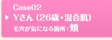 Case02 Yさん（26歳・混合肌）毛穴が気になる箇所：頬