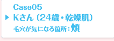 Case05 Kさん（24歳・乾燥肌）毛穴が気になる箇所：頬