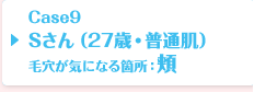 Case09 Sさん（27歳・普通肌）毛穴が気になる箇所：頬